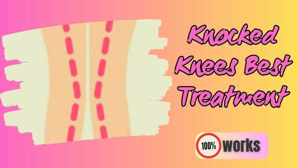 Knocked Knees : Symptoms, Causes And 3 Best Remedies