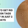 Say Goodbye To Skin Tags: Effective Ways To Remove Them Safely